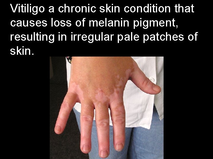Vitiligo a chronic skin condition that causes loss of melanin pigment, resulting in irregular