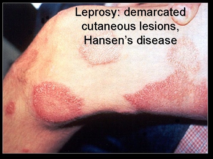 Leprosy: demarcated cutaneous lesions, Hansen’s disease 