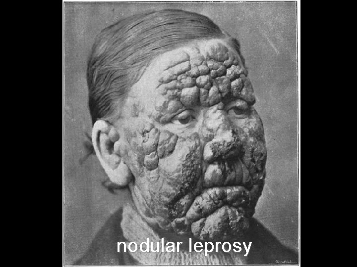 nodular leprosy 