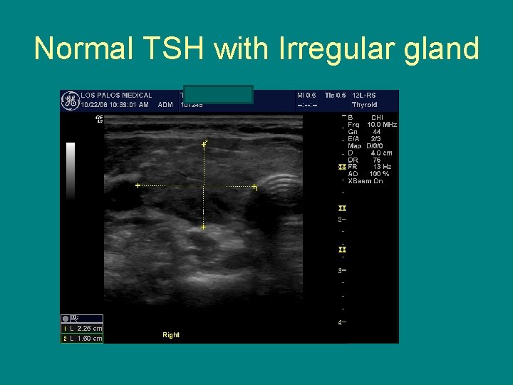 Normal TSH with Irregular gland 