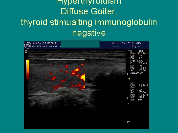 Hyperthyroidism Diffuse Goiter, thyroid stimualting immunoglobulin negative 