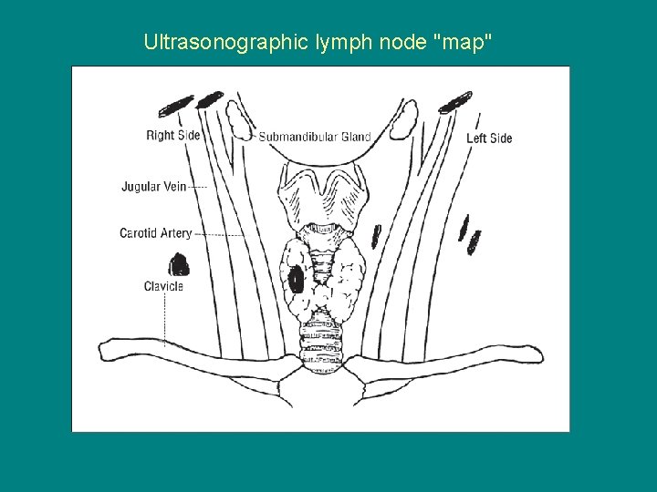 Ultrasonographic lymph node "map" 