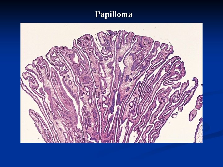 Papilloma 