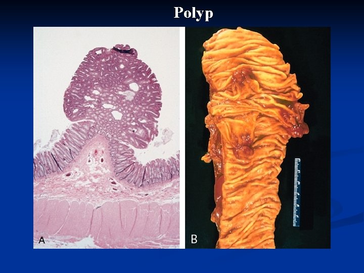 Polyp 