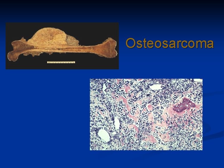 Osteosarcoma 