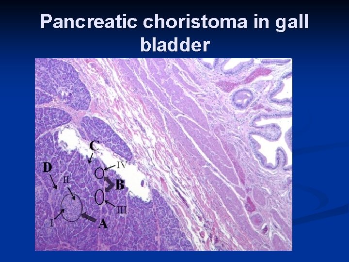 Pancreatic choristoma in gall bladder 