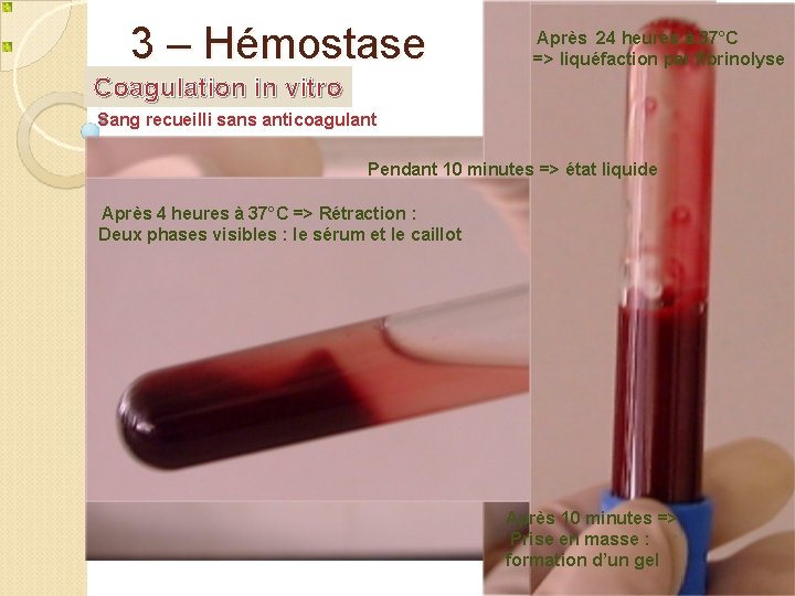 3 – Hémostase Après 24 heures à 37°C => liquéfaction par fibrinolyse Coagulation in