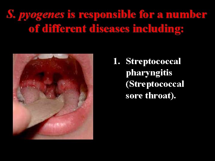 S. pyogenes is responsible for a number of different diseases including: 1. Streptococcal pharyngitis
