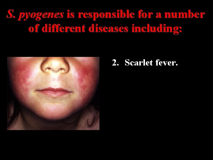 S. pyogenes is responsible for a number of different diseases including: 2. Scarlet fever.