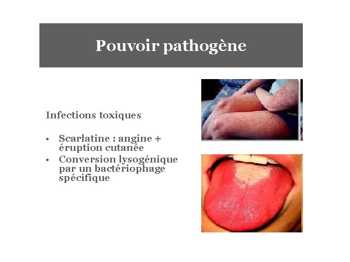 Pouvoir pathogène Infections toxiques • Scarlatine : angine + éruption cutanée • Conversion lysogénique