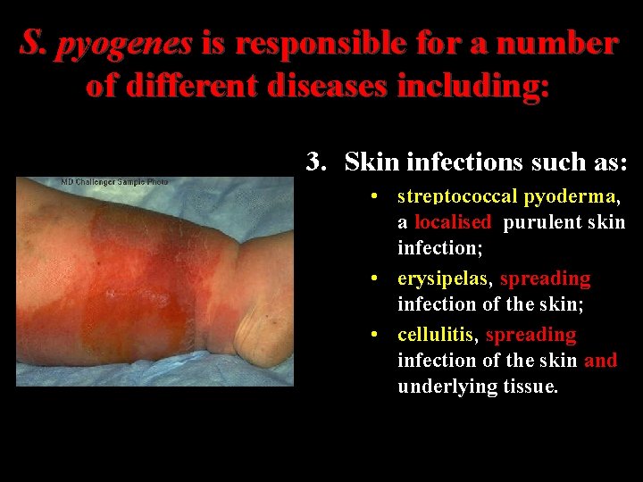 S. pyogenes is responsible for a number of different diseases including: 3. Skin infections