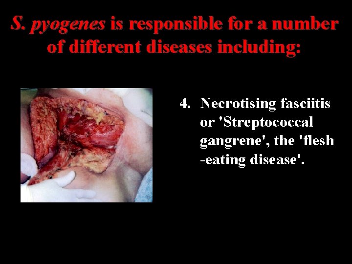 S. pyogenes is responsible for a number of different diseases including: 4. Necrotising fasciitis