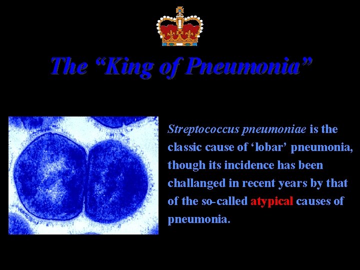 The “King of Pneumonia” Streptococcus pneumoniae is the classic cause of ‘lobar’ pneumonia, though