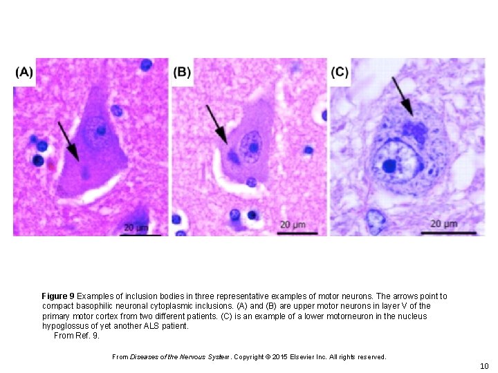 Figure 9 Examples of inclusion bodies in three representative examples of motor neurons. The