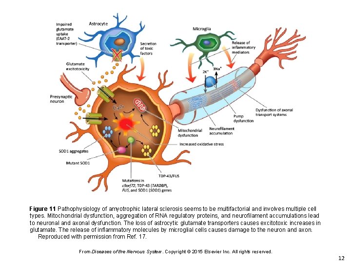 Figure 11 Pathophysiology of amyotrophic lateral sclerosis seems to be multifactorial and involves multiple