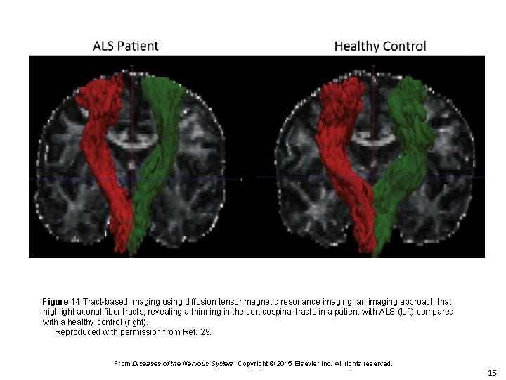 Figure 14 Tract-based imaging using diffusion tensor magnetic resonance imaging, an imaging approach that
