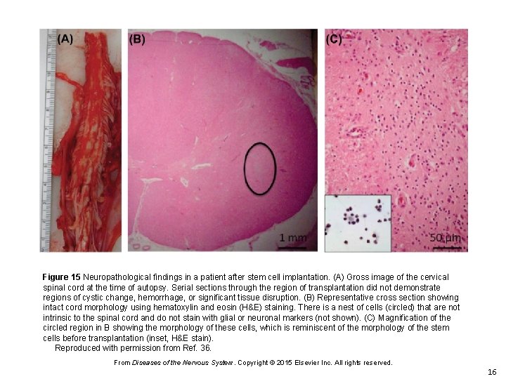 Figure 15 Neuropathological findings in a patient after stem cell implantation. (A) Gross image