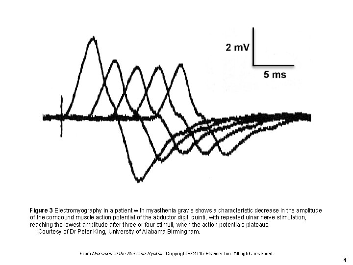 Figure 3 Electromyography in a patient with myasthenia gravis shows a characteristic decrease in