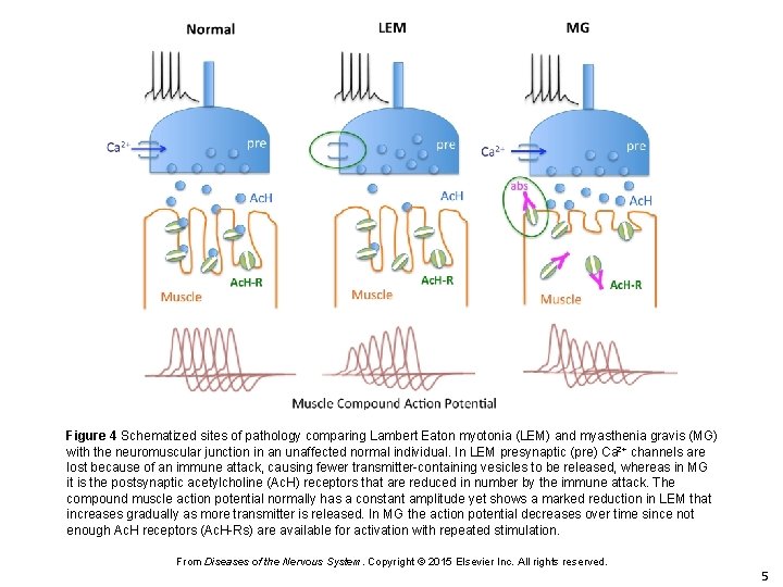 Figure 4 Schematized sites of pathology comparing Lambert Eaton myotonia (LEM) and myasthenia gravis