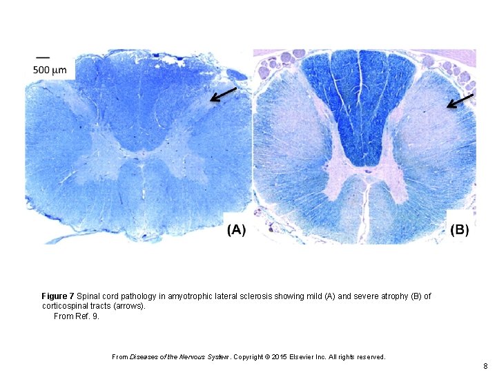 Figure 7 Spinal cord pathology in amyotrophic lateral sclerosis showing mild (A) and severe