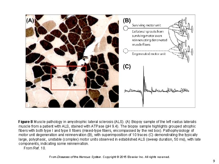 Figure 8 Muscle pathology in amyotrophic lateral sclerosis (ALS). (A) Biopsy sample of the