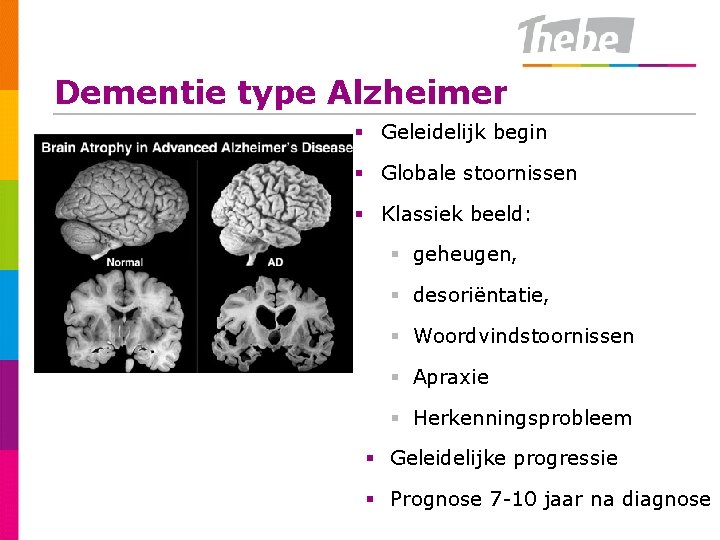 Dementie type Alzheimer § Geleidelijk begin § Globale stoornissen § Klassiek beeld: § geheugen,