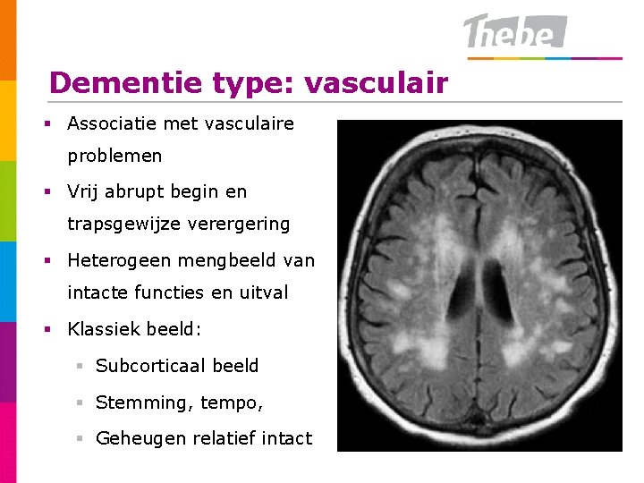 Dementie type: vasculair § Associatie met vasculaire problemen § Vrij abrupt begin en trapsgewijze