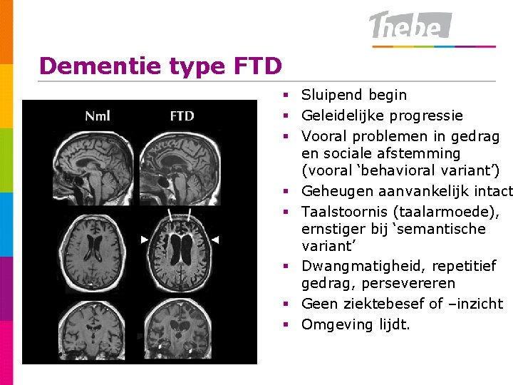 Dementie type FTD § Sluipend begin § Geleidelijke progressie § Vooral problemen in gedrag