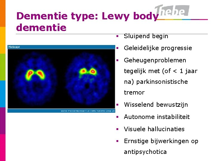 Dementie type: Lewy body dementie § Sluipend begin § Geleidelijke progressie § Geheugenproblemen tegelijk