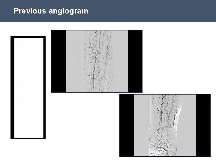 Previous angiogram SPL 61580 Rev. B 