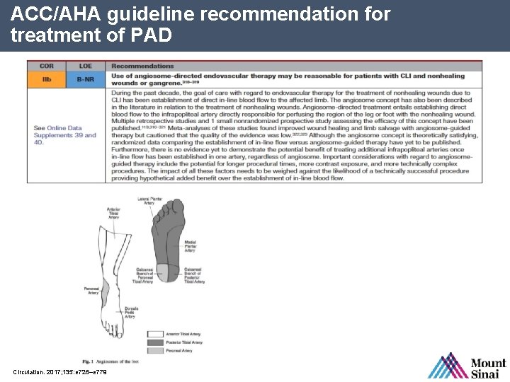 ACC/AHA guideline recommendation for treatment of PAD Circulation. 2017; 135: e 726–e 779 SPL