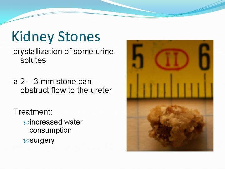 Kidney Stones crystallization of some urine solutes a 2 – 3 mm stone can