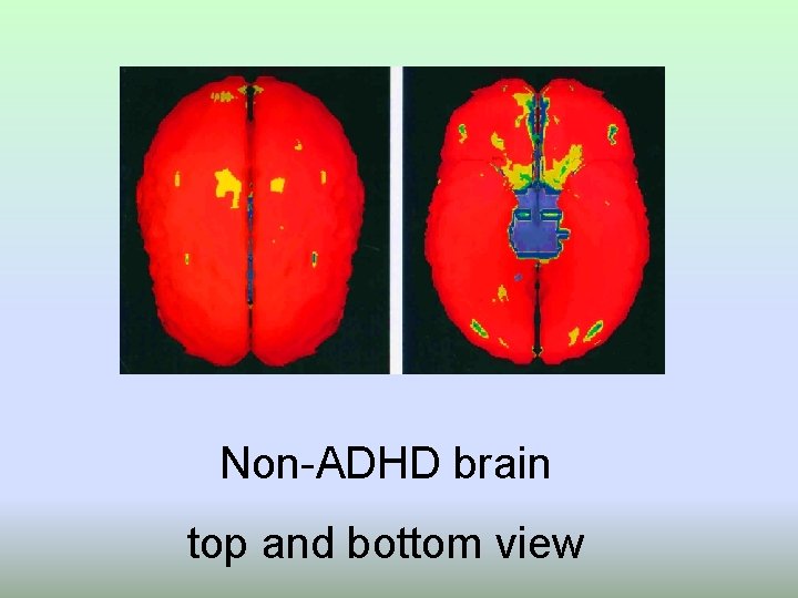 Non-ADHD brain top and bottom view 