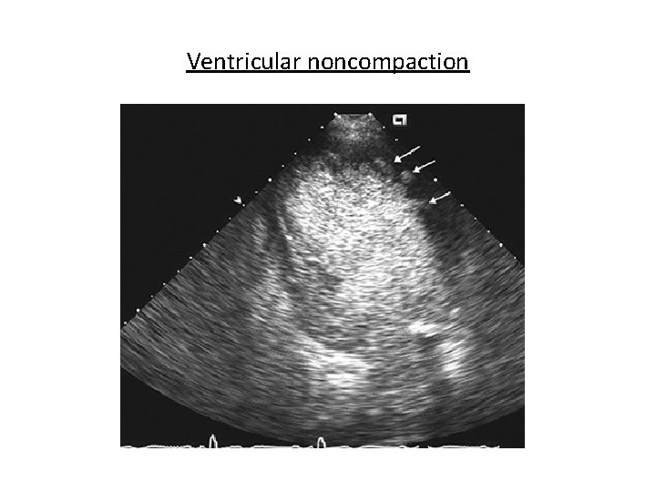 Ventricular noncompaction 