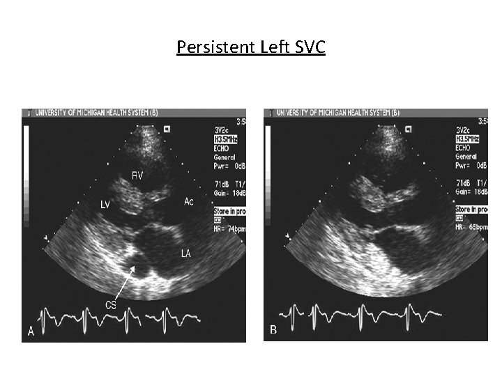 Persistent Left SVC 