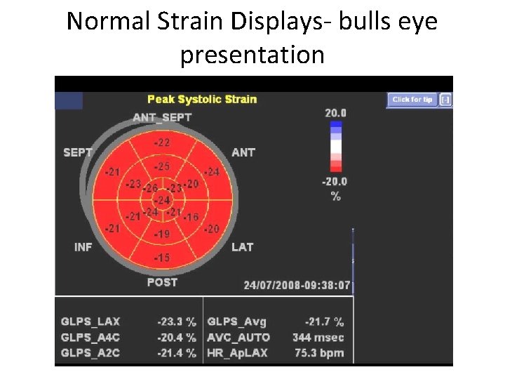 Normal Strain Displays- bulls eye presentation 