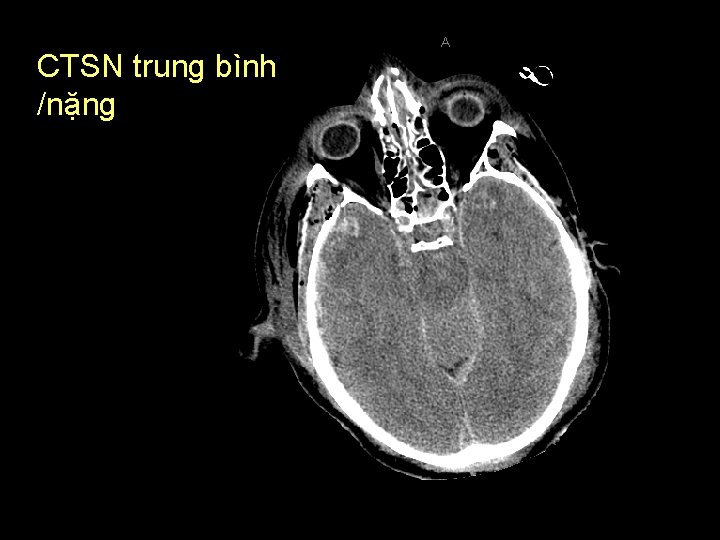 CTSN trung bình /nặng 