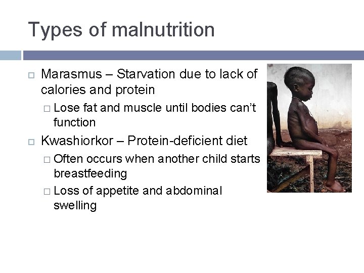 Types of malnutrition Marasmus – Starvation due to lack of calories and protein � Types of malnutrition Marasmus – Starvation due to lack of calories and protein �