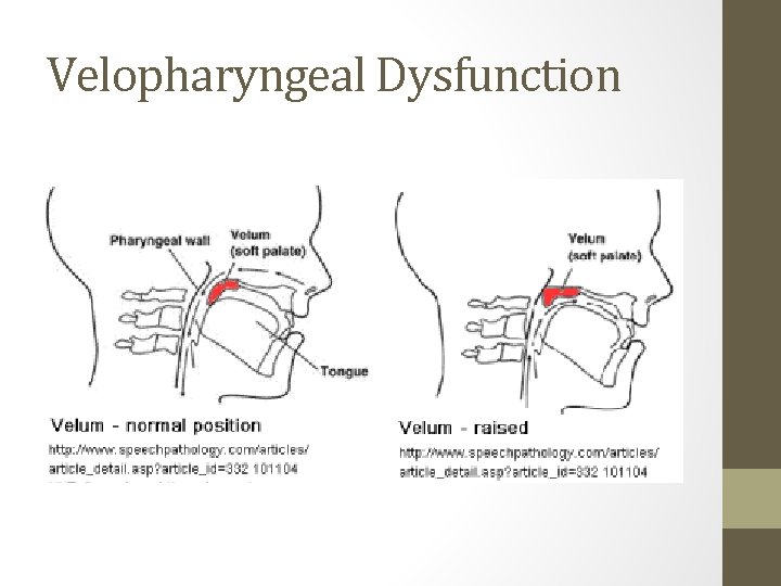 Velopharyngeal Dysfunction Velopharyngeal Dysfunction