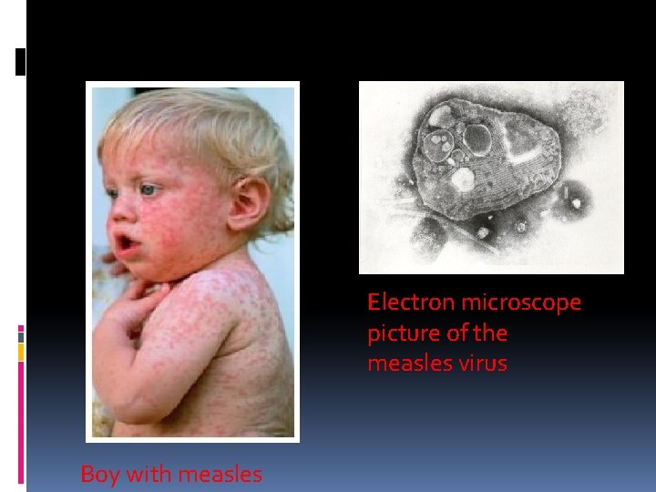 Measles virus Electron microscope picture of the measles virus Boy with measles 