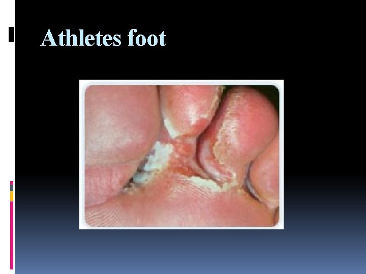 Athletes foot 