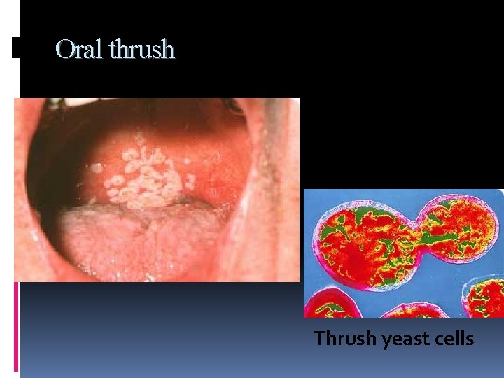 Oral thrush Thrush yeast cells 