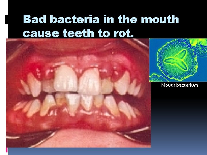 Bad bacteria in the mouth cause teeth to rot. Mouth bacteria Mouth bacterium 