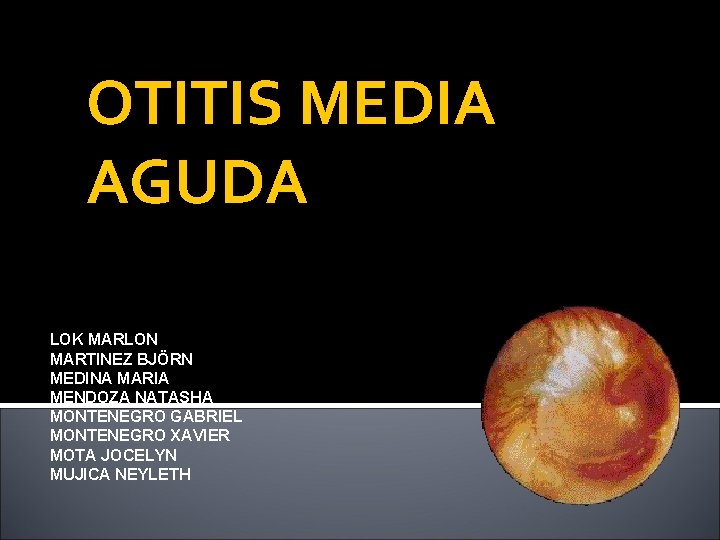 OTITIS MEDIA AGUDA LOK MARLON MARTINEZ BJÖRN MEDINA MARIA MENDOZA NATASHA MONTENEGRO GABRIEL MONTENEGRO