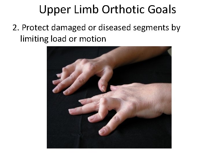 Upper Limb Orthotic Goals 2. Protect damaged or diseased segments by limiting load or