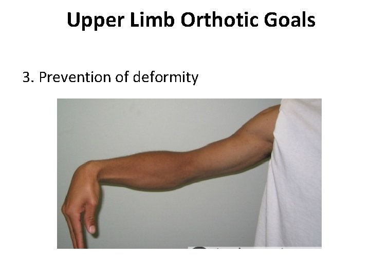 Upper Limb Orthotic Goals 3. Prevention of deformity 