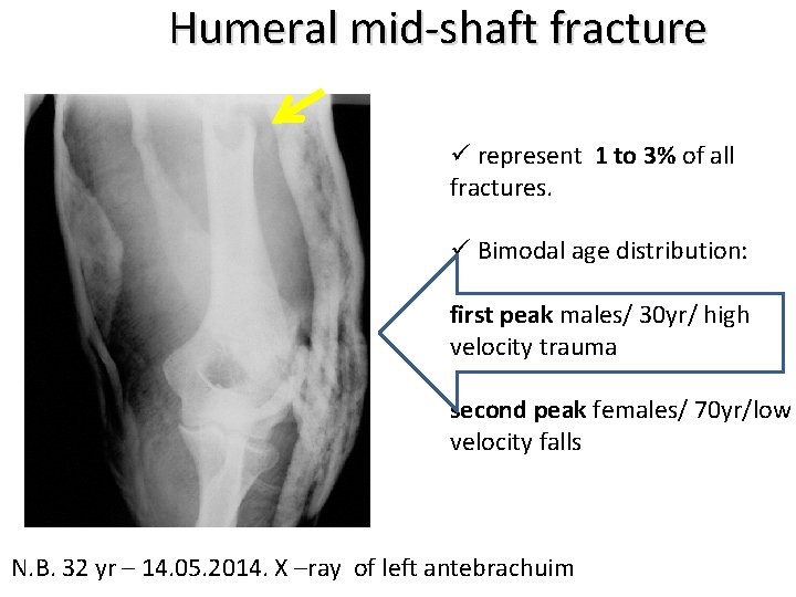 Humeral mid-shaft fracture ü represent 1 to 3% of all fractures. ü Bimodal age