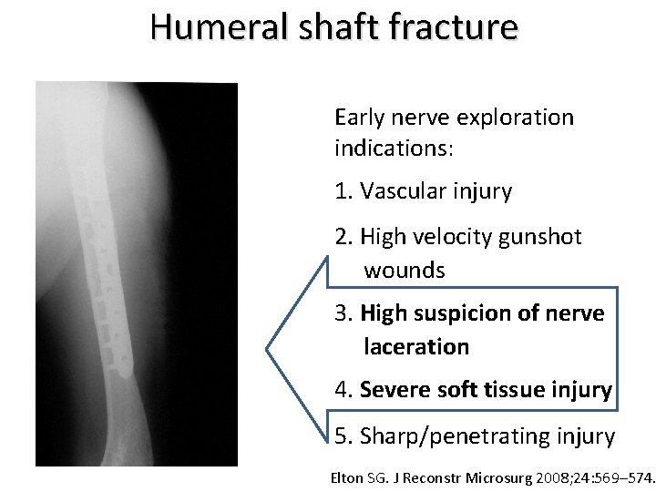 Humeral shaft fracture Early nerve exploration indications: 1. Vascular injury 2. High velocity gunshot