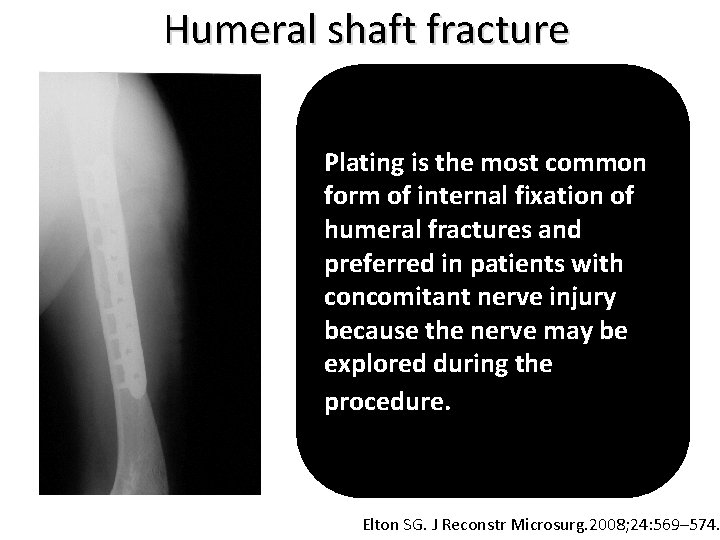 Humeral shaft fracture Plating is the most common form of internal fixation of humeral