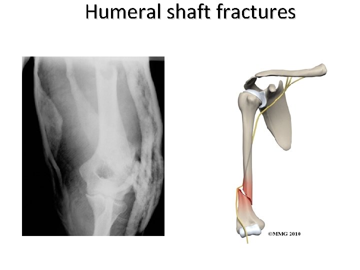 Humeral shaft fractures 